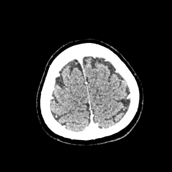Cerebral ring enhancing lesions - cerebral metastases (Radiopaedia 44922-48818 B 249).jpg