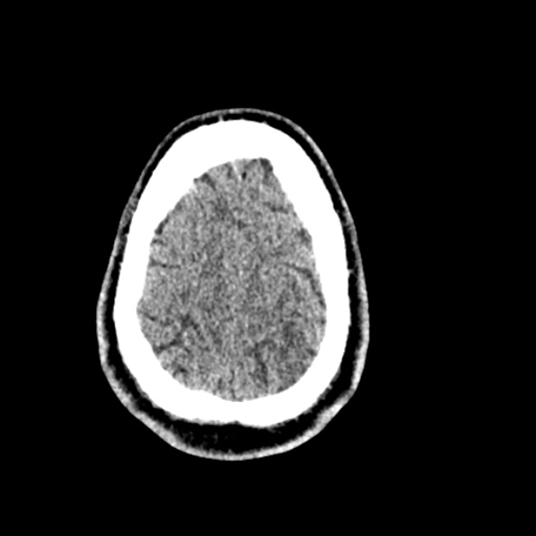 Cerebral toxoplasmosis (Radiopaedia 53993-60131 Axial non-contrast 69).jpg