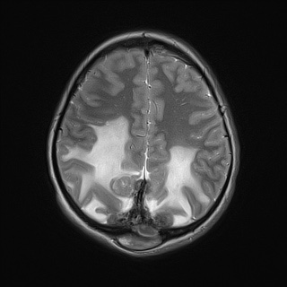 File:Cerebral tuberculosis with dural sinus invasion (Radiopaedia 60353-68090 Axial T2 18).jpg