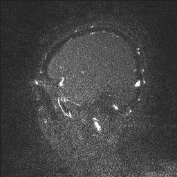 Cerebral tuberculosis with dural sinus invasion (Radiopaedia 60353-68090 Sagittal MRV 19).jpg