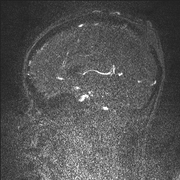 Cerebral tuberculosis with dural sinus invasion (Radiopaedia 60353-68090 Sagittal MRV 80).jpg