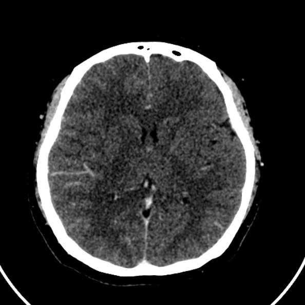 File:Cerebral venous hemorrhagic infarct from venous sinus thrombosis (Radiopaedia 55433-61883 Axial C+ delayed 73).jpg