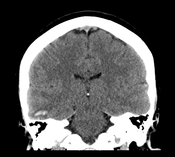 File:Cerebral venous infarct related to dural venous sinus thromboses (Radiopaedia 35292-36804 Coronal non-contrast 21).png