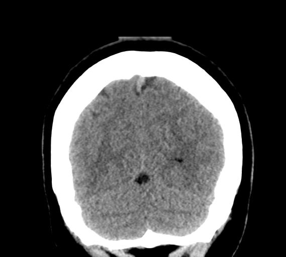 File:Cerebral venous infarct related to dural venous sinus thromboses (Radiopaedia 35292-36804 Coronal non-contrast 30).png