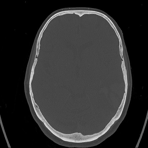 Cerebral venous infarction with hemorrhage (Radiopaedia 65343-74381 Axial bone window 73).jpg