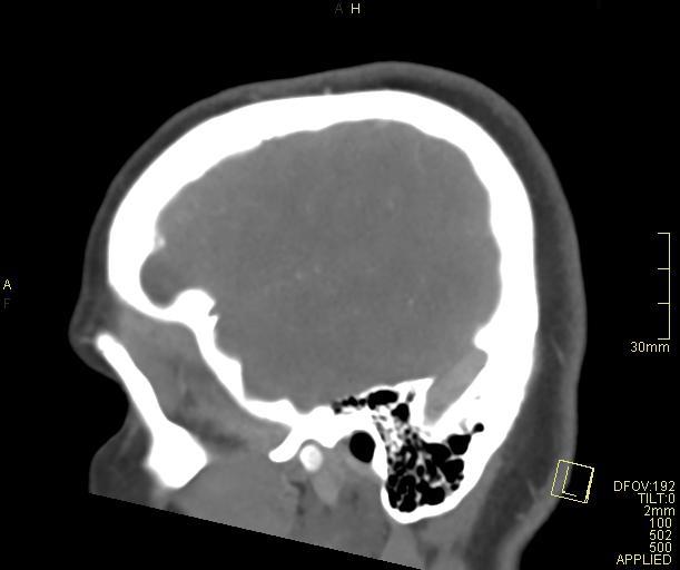 Cerebral venous sinus thrombosis (Radiopaedia 91329-108965 Sagittal venogram 13).jpg
