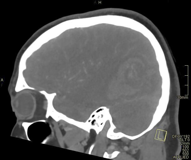 File:Cerebral venous sinus thrombosis (Radiopaedia 91329-108965 Sagittal venogram 56).jpg