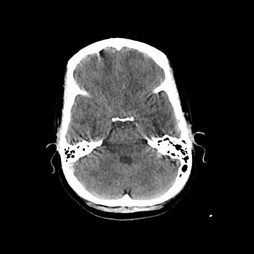 Cerebral venous throbmosis - hemorrhagic venous infarction (Radiopaedia 87318-103613 Axial non-contrast 47).jpg