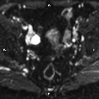 File:Cervical adenocarcinoma (Radiopaedia 65011-73985 Axial DWI 55).jpg