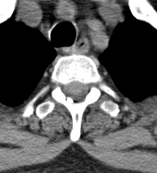Cervical canal stenosis - OPLL and osteophytes (Radiopaedia 47329-51910 Axial non-contrast 63).png