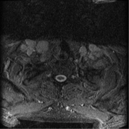 Cervical canal stenosis with cord compression (Radiopaedia 34114-35374 Axial Gradient Echo 3).png
