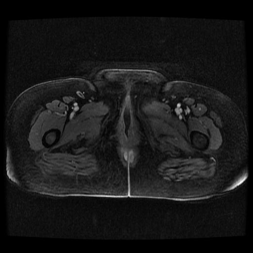 Cervical carcinoma (Radiopaedia 70924-81132 Axial T1 C+ fat sat 16).jpg