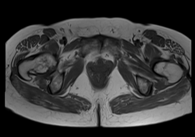 File:Cervical carcinoma (Radiopaedia 88312-104943 Axial T1 18).jpg
