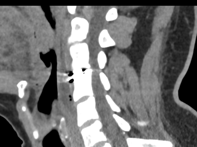 Cervical disc replacement (Radiopaedia 44025-47541 B 45).png