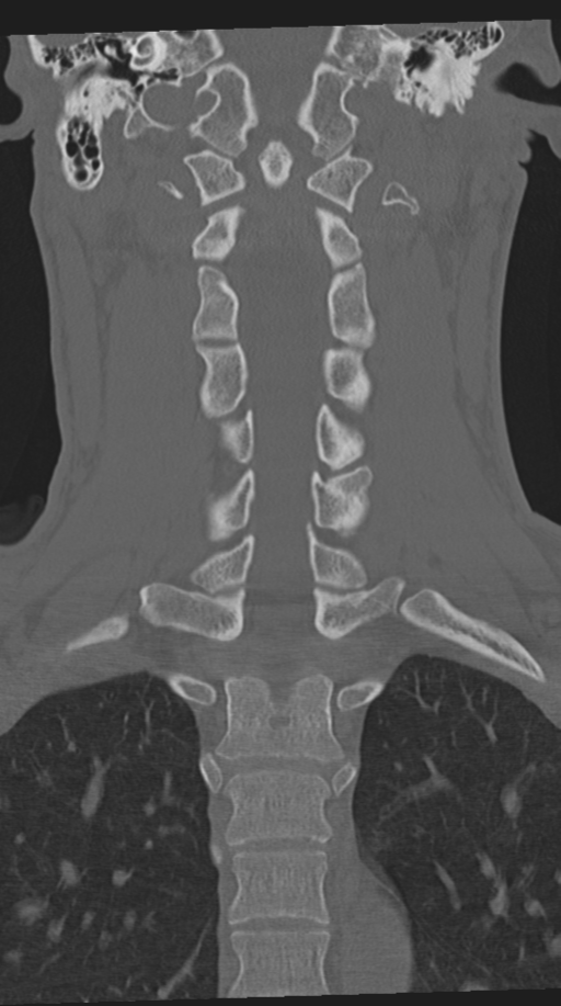 Cervical intercalary bone (Radiopaedia 35211-36748 Coronal bone window 43).png
