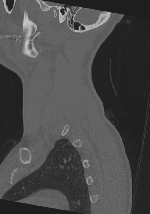 Cervical intercalary bone (Radiopaedia 35211-36748 Sagittal bone window 11).png
