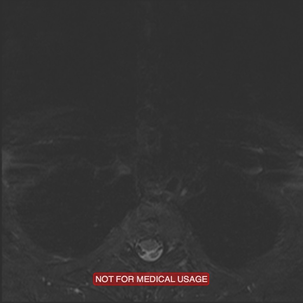 Cervical nerve schwannoma (Radiopaedia 27964-28221 C 49).jpg