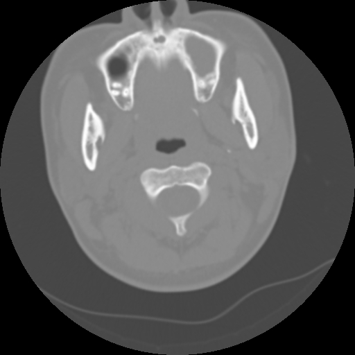 Cervical rib (Radiopaedia 71110-81363 Axial non-contrast 20).jpg