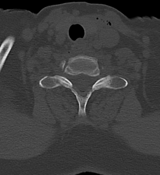 Cervical spine ACDF loosening (Radiopaedia 48998-54070 Axial bone window 47).png