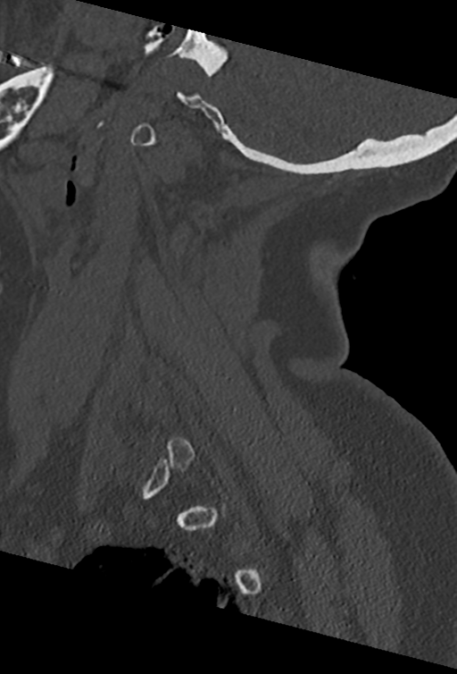 Cervical spine ACDF loosening (Radiopaedia 48998-54070 Sagittal bone window 23).png