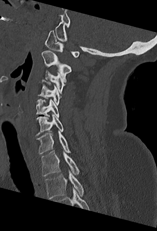 Cervical spine ACDF loosening (Radiopaedia 48998-54070 Sagittal bone window 53).png
