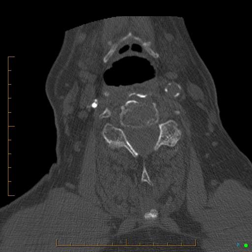 Cervical spine fracture - ankylosing spondylitis (Radiopaedia 76835-88706 Axial bone window 119).jpg