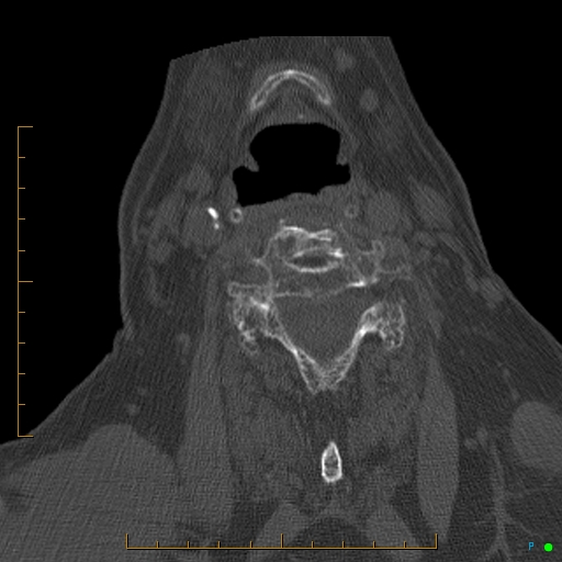 File:Cervical spine fracture - ankylosing spondylitis (Radiopaedia 76835-88706 Axial bone window 130).jpg