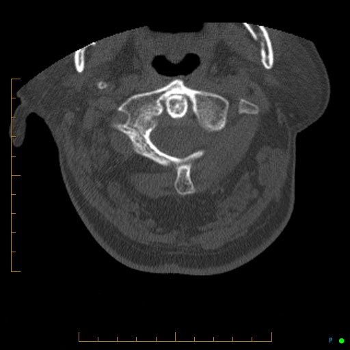 File:Cervical spine fracture - ankylosing spondylitis (Radiopaedia 76835-88706 Axial bone window 34).jpg