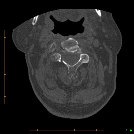 Cervical spine fracture - ankylosing spondylitis (Radiopaedia 76835-88706 Axial bone window 72).jpg
