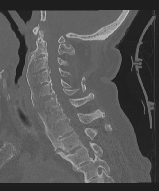 Cervical spine fracture in the setting of ankylosis (Radiopaedia 37038-38715 Sagittal bone window 38).png