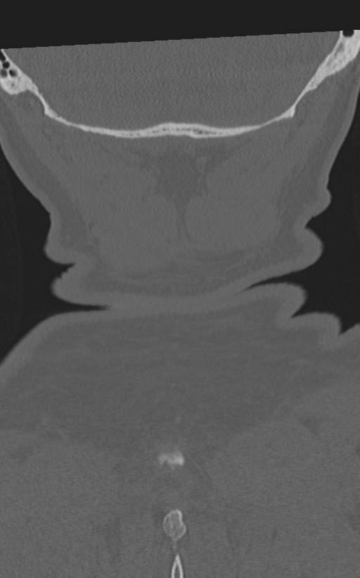 Cervical spine fractures with vertebral artery dissection (Radiopaedia 53296-59268 Coronal bone window 68).png