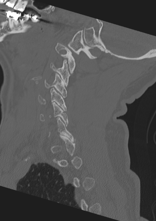 Cervical spine fractures with vertebral artery dissection (Radiopaedia 53296-59268 Sagittal bone window 49).png