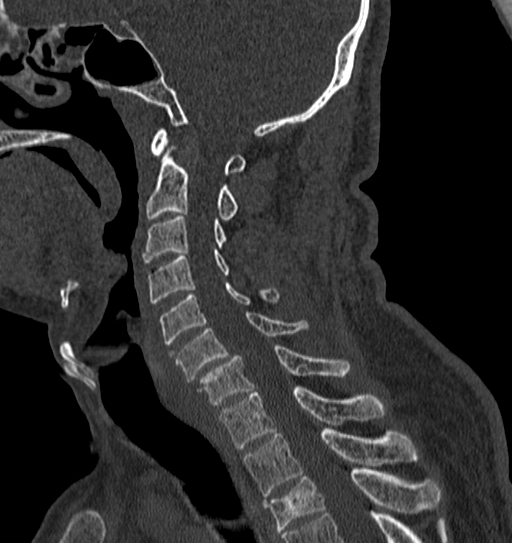 Cervical spine trauma with tear drop fracture and perched facet joint (Radiopaedia 53989-60127 Sagittal bone window 72).jpg