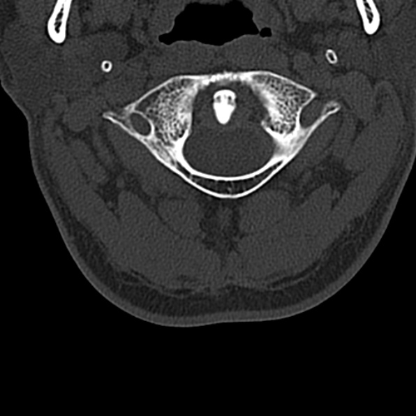 Cervical spondylodiscitis (Radiopaedia 28057-29489 Axial bone window 17).jpg
