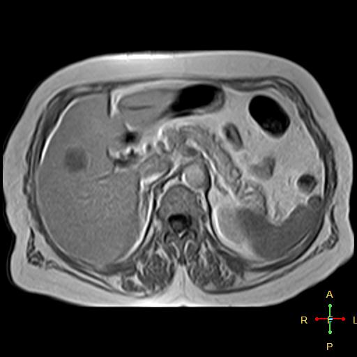 File:Cervical stump squamous cell carcinoma (Radiopaedia 48049-52858 H 8).jpg