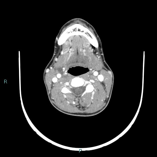 Cervical thymic cyst (Radiopaedia 88632-105335 B 67).jpg
