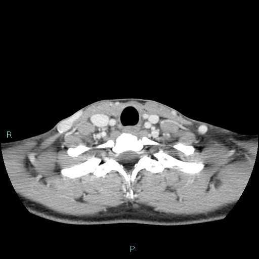 Cervical thymic cyst (Radiopaedia 88632-105335 C 37).jpg