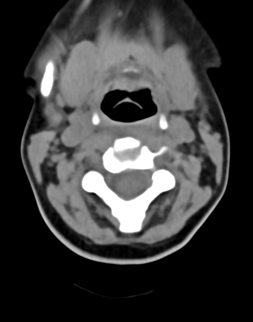 Cervical tuberculous spondylitis (Radiopaedia 39149-41365 Axial non-contrast 19).png