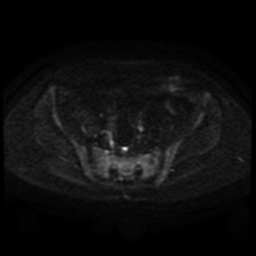 Cesarian section scar endometriosis (Radiopaedia 66520-75799 Axial DWI 81).jpg