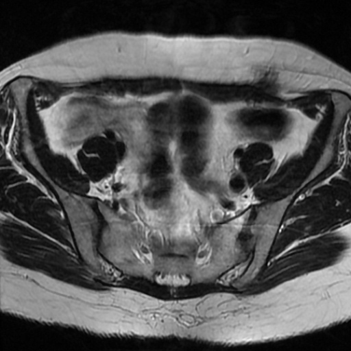 File:Cesarian section scar endometriosis (Radiopaedia 66520-75799 Axial T2 4).jpg