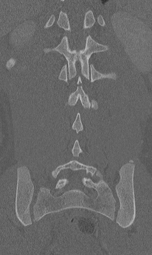 Chance fracture (Radiopaedia 40360-42912 Coronal bone window 50).png