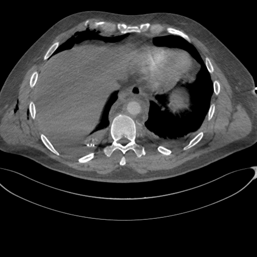 File:Chest multitrauma - aortic injury (Radiopaedia 34708-36147 A 231).png