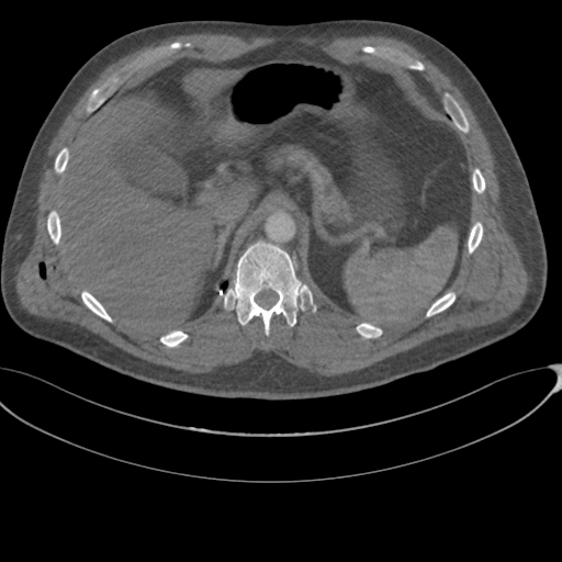 File:Chest multitrauma - aortic injury (Radiopaedia 34708-36147 A 289).png