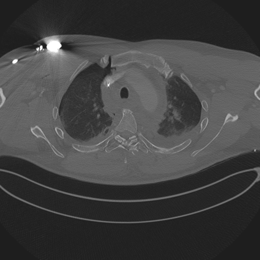 Chest multitrauma - aortic injury (Radiopaedia 34708-36147 Axial bone window 79).png