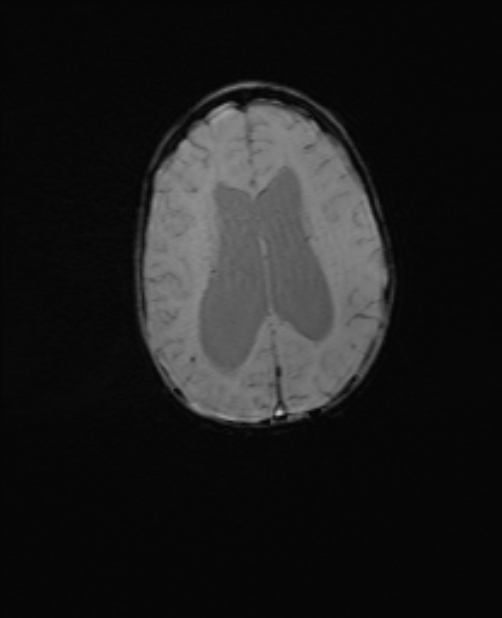 Chiari III malformation with occipital encephalocele (Radiopaedia 79446-92559 Axial SWI 44).jpg