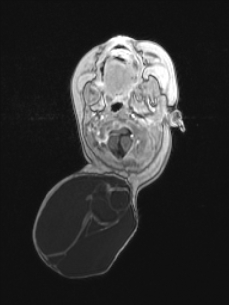 Chiari III malformation with occipital encephalocele (Radiopaedia 79446-92559 Axial T1 C+ mpr 29).jpg