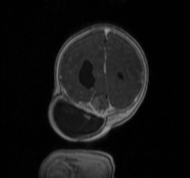 Chiari III malformation with occipital encephalocele (Radiopaedia 79446-92559 Coronal T1 C+ mpr 41).jpg