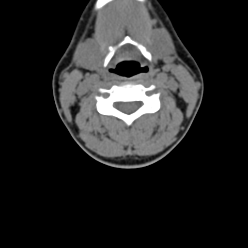 Chiari I malformation and obstructive hydrocephalus (Radiopaedia 41185-43981 D 51).png