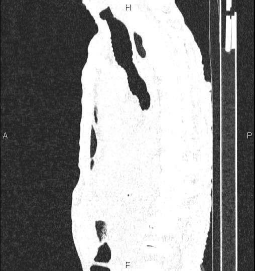 Chilaiditi sign (Radiopaedia 88839-105611 Sagittal lung window 53).jpg