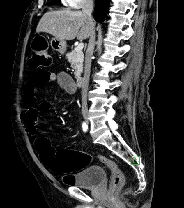 Cholangiocarcinoma with cerebral metastases (Radiopaedia 83519-98629 F 67).jpg